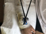 Раздробленную руку восстановили парню шымкентские врачи