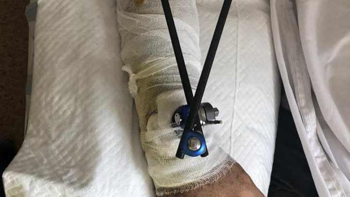 Раздробленную руку восстановили парню шымкентские врачи