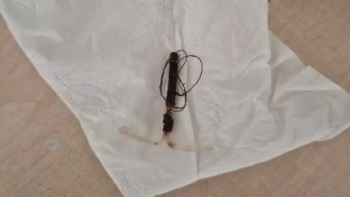 Спираль, повредившая толстую кишку, успешно удалена у пациентки в Шымкенте