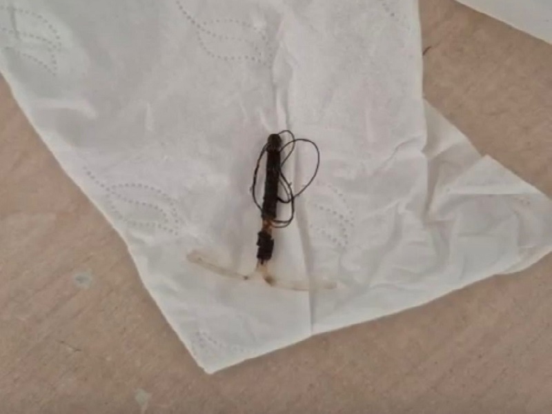 Спираль, повредившая толстую кишку, успешно удалена у пациентки в Шымкенте