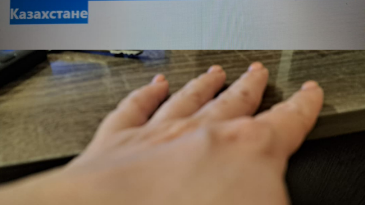 Всплеск заболеваемости корью отмечается в Казахстане