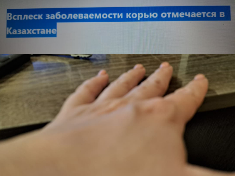 Всплеск заболеваемости корью отмечается в Казахстане